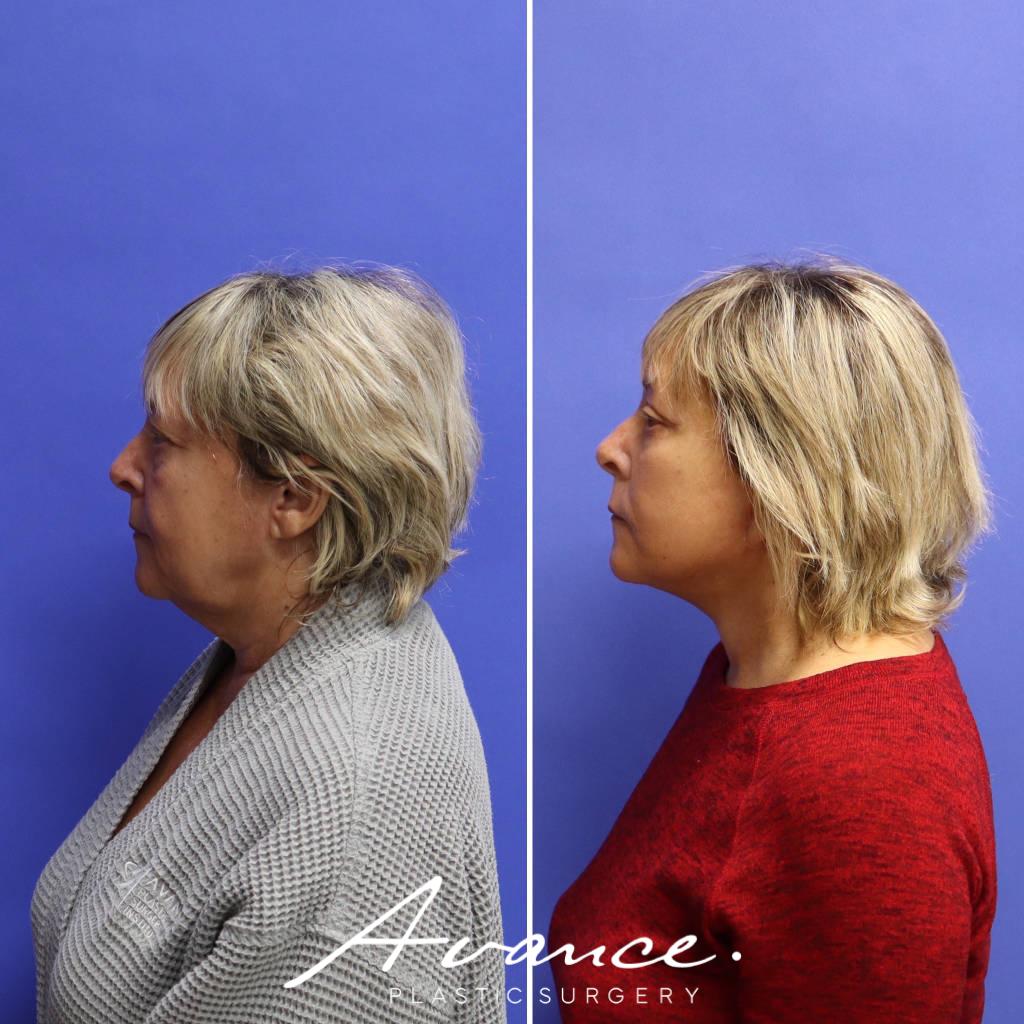 Before and After - Facelift/Necklift & Minifacelift/Necklift
