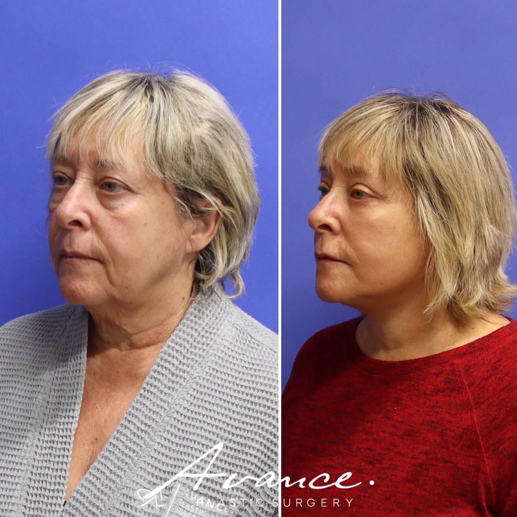 Before and After - Facelift/Necklift & Minifacelift/Necklift