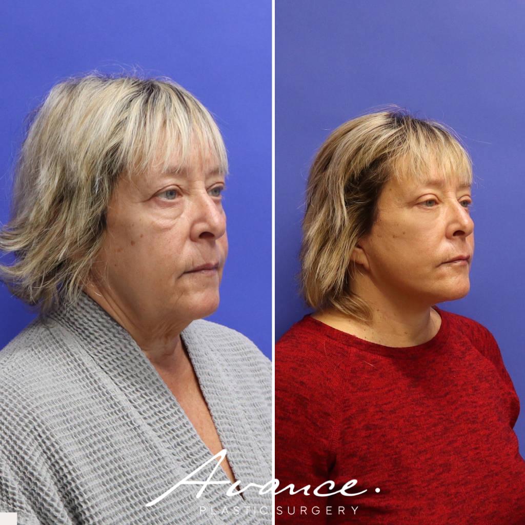 Before and After - Facelift/Necklift & Minifacelift/Necklift