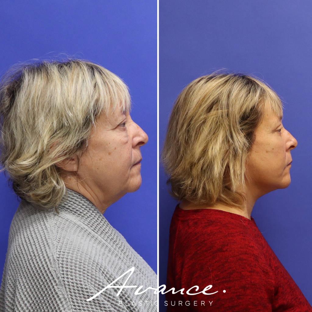 Before and After - Facelift/Necklift & Minifacelift/Necklift