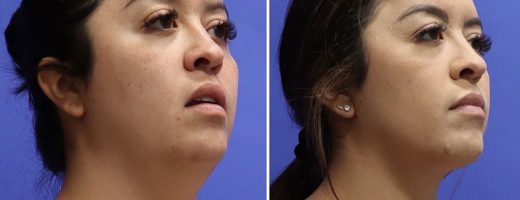 Before and After - Neck Liposuction