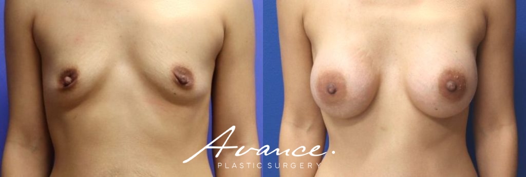Before and After - Breast Augmentation