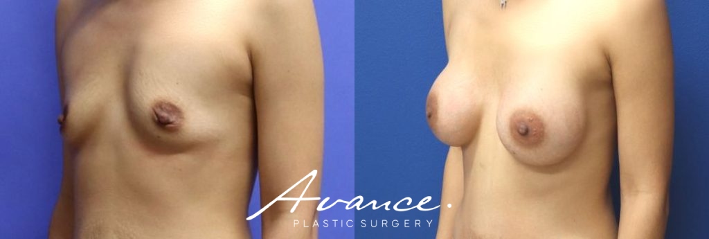 Before and After - Breast Augmentation