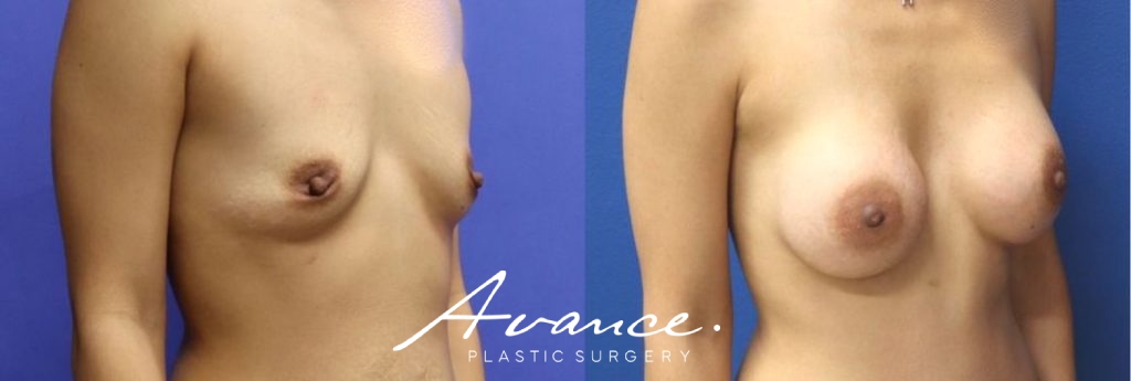 Before and After - Breast Augmentation