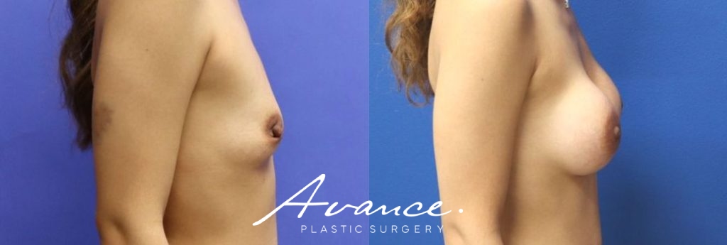 Before and After - Breast Augmentation