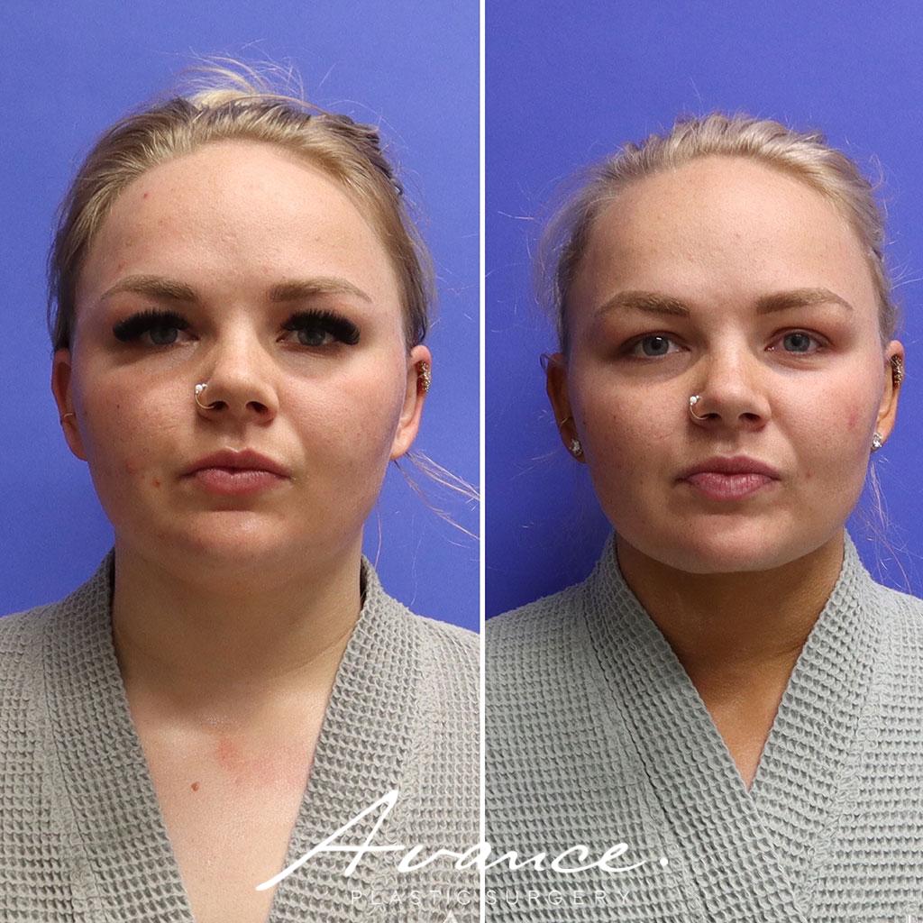 Before and After - Liposucción de cuello