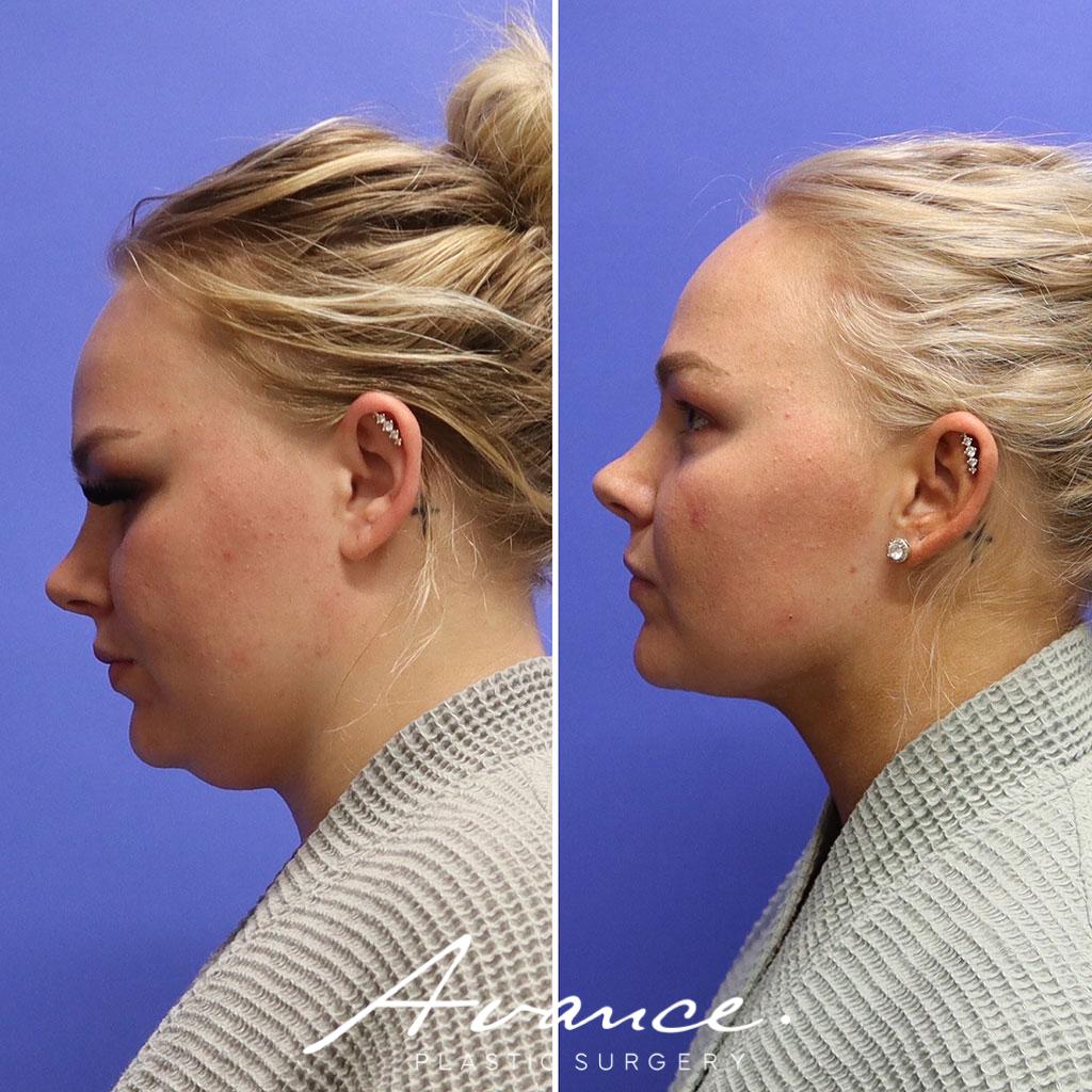 Before and After - Liposucción de cuello
