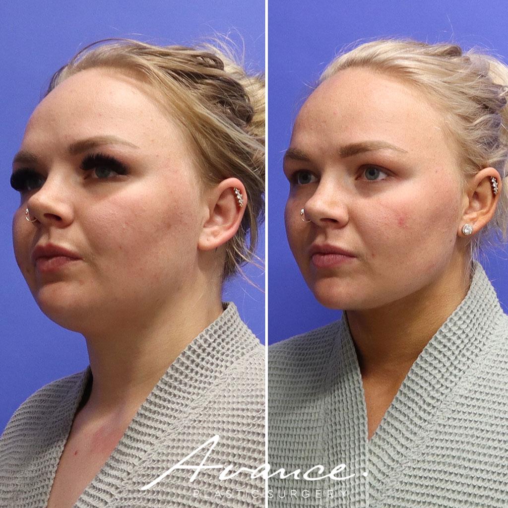 Before and After - Liposucción de cuello