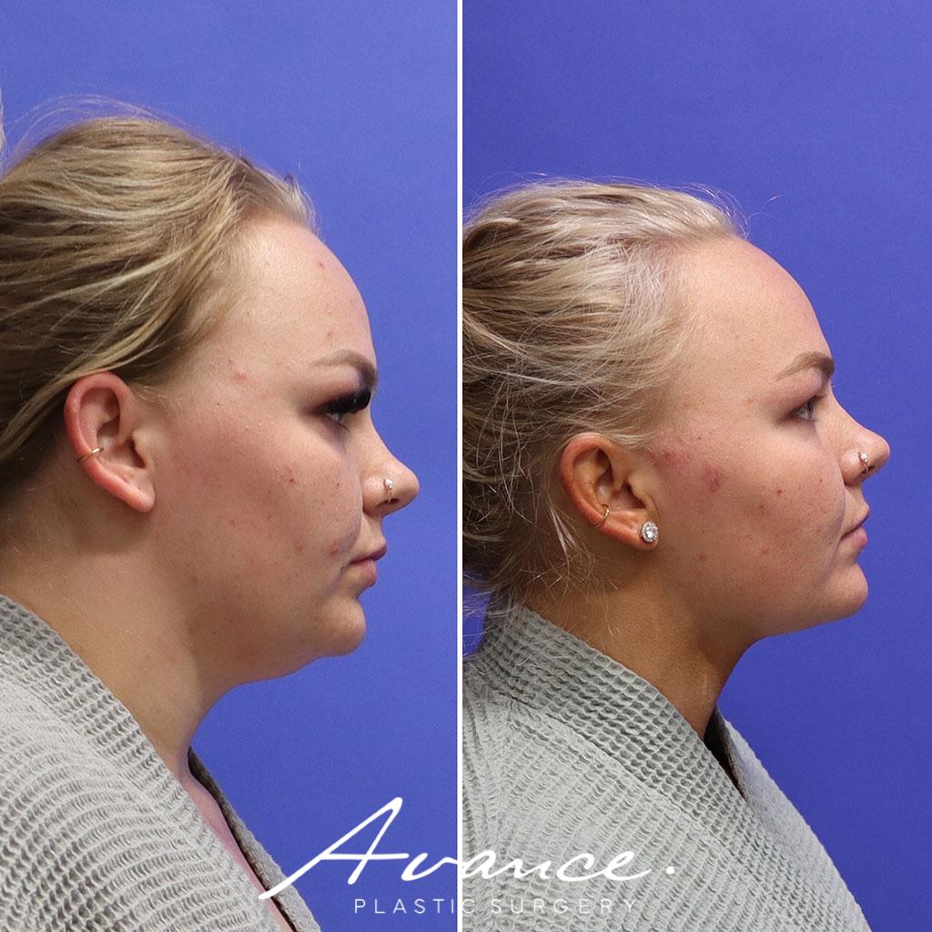 Before and After - Liposucción de cuello