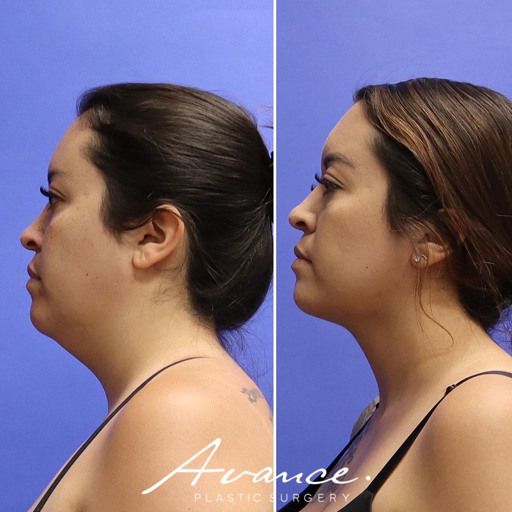 Before and After - Liposucción de cuello