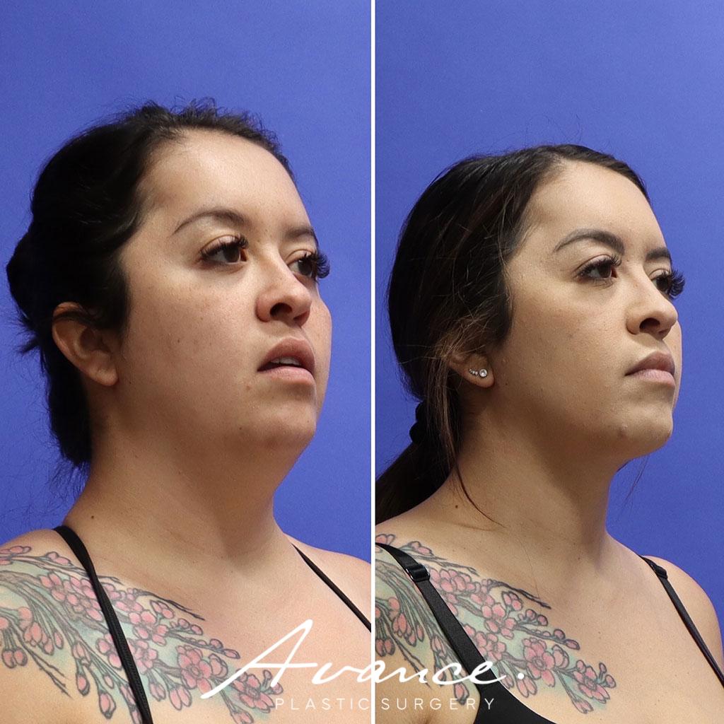 Before and After - Liposucción de cuello