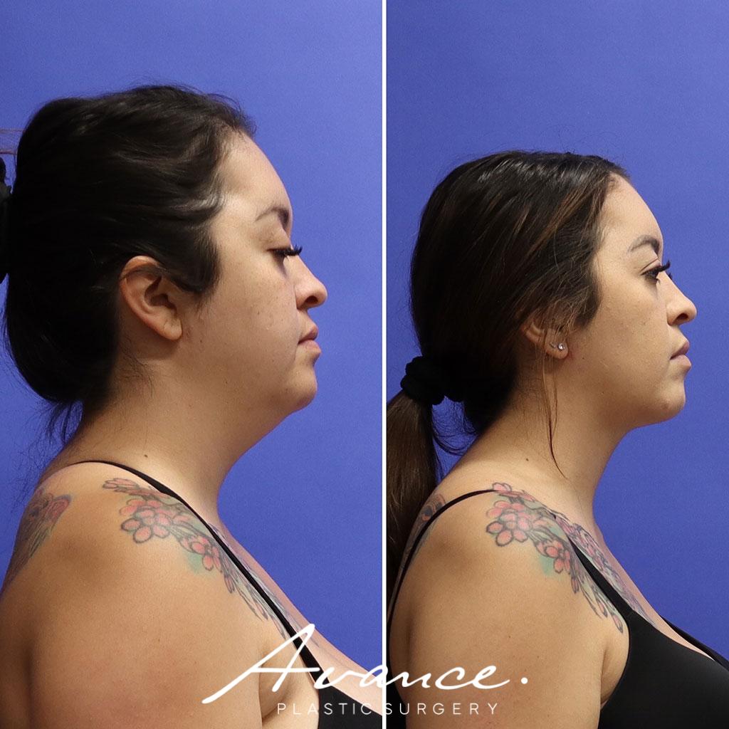 Before and After - Liposucción de cuello