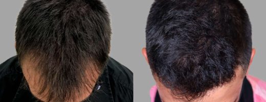 Before and After - Hair
