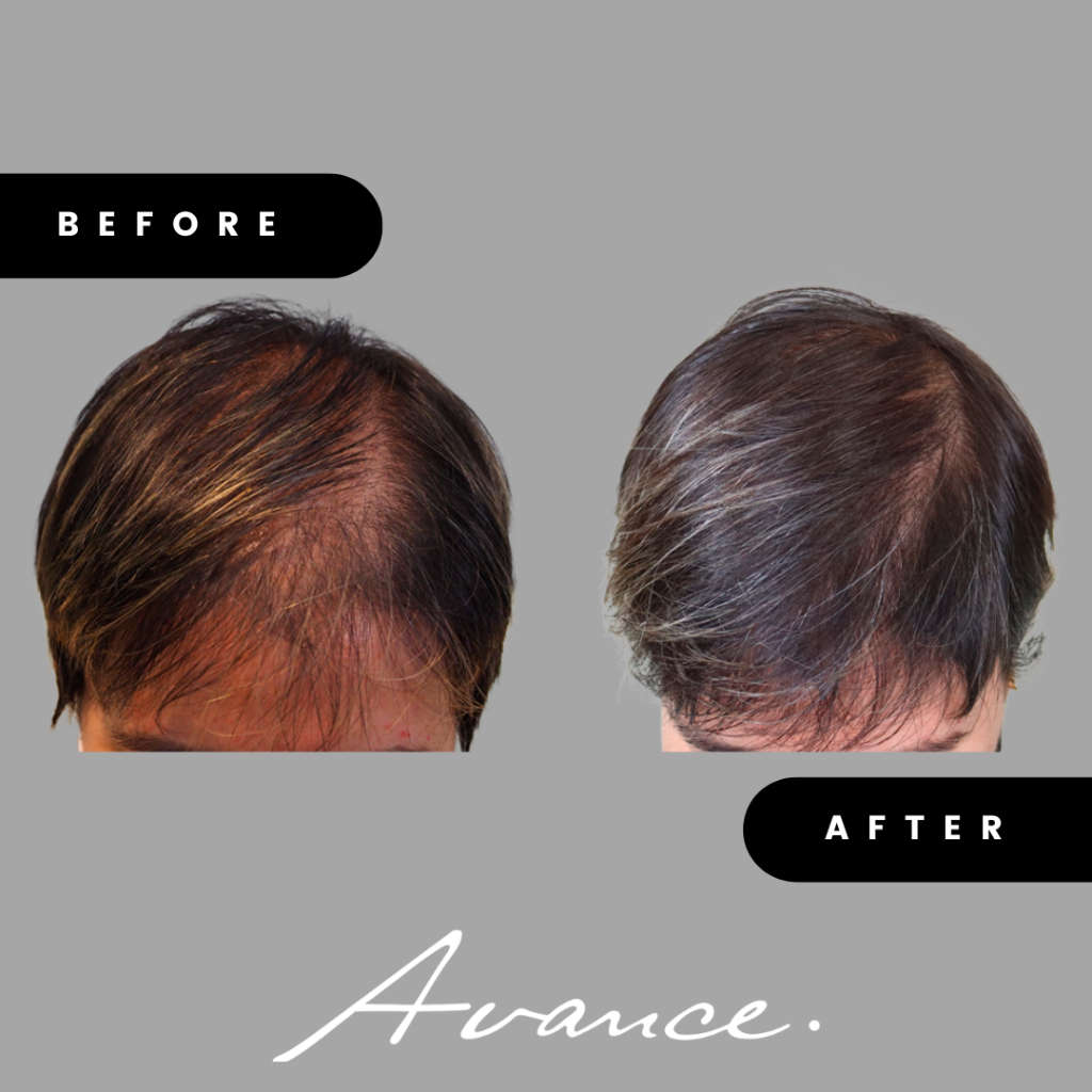 Before and After - Hair Transplant