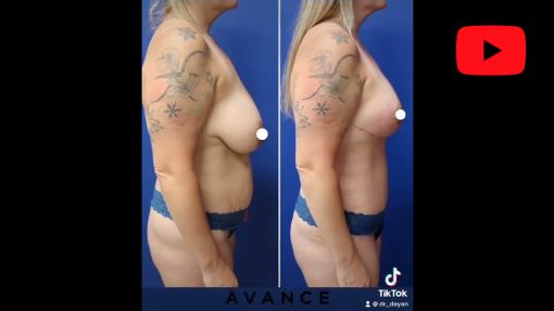 YouTube video titled Reno NV Mommy Makeover with Breast Lift & Tummy Tuck | Dr. Erez Dayan