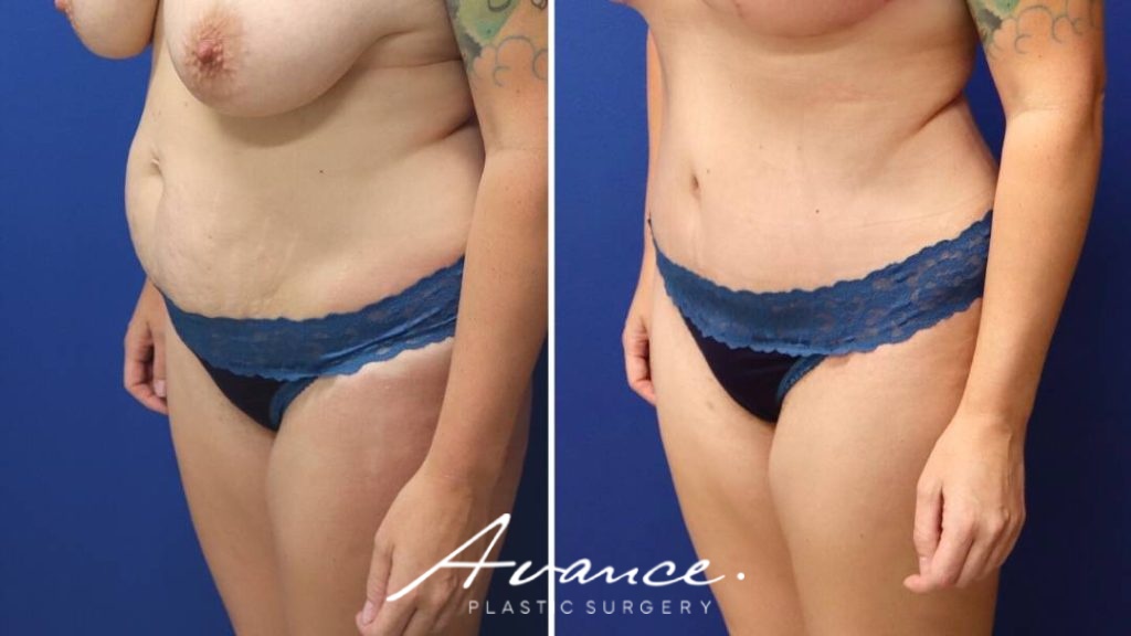 Before and After - Abdominoplasty