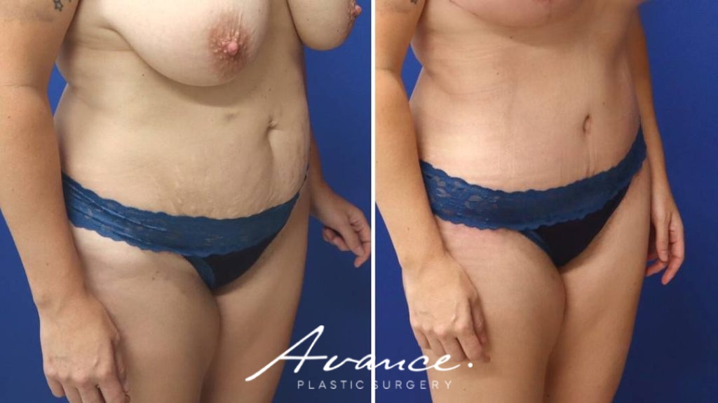 Before and After - Abdominoplasty