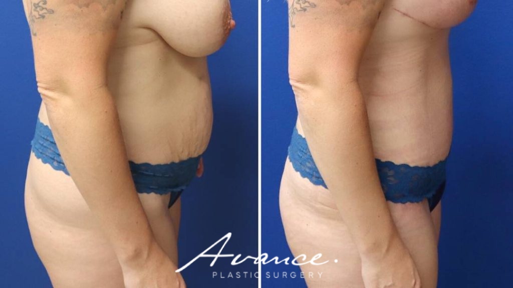 Before and After - Abdominoplasty