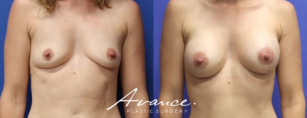Before and After - Aumento de pecho