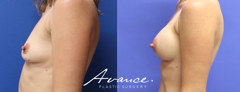 Before and After - Aumento de pecho