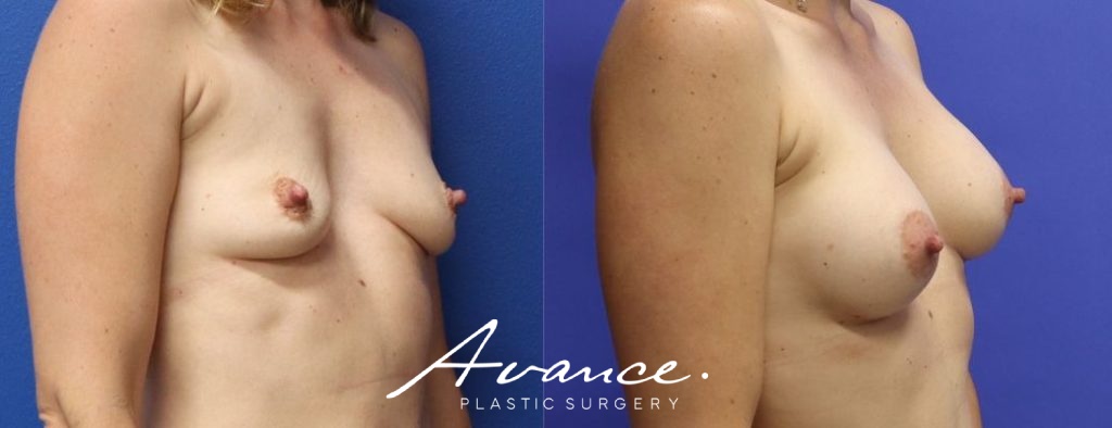 Before and After - Aumento de pecho