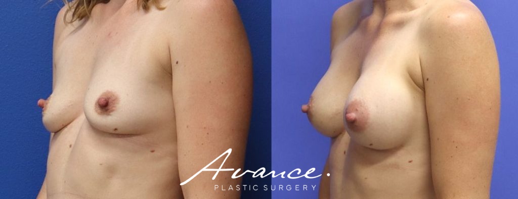 Before and After - Aumento de pecho
