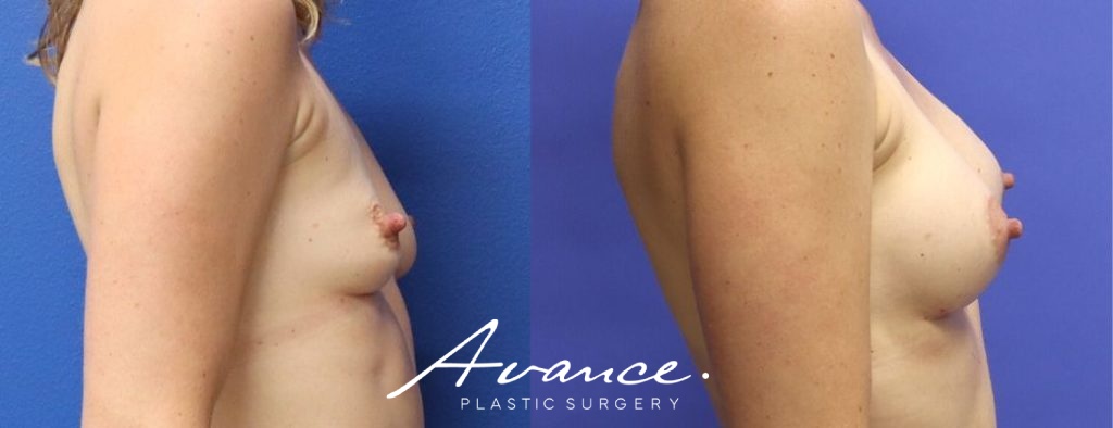 Before and After - Aumento de pecho
