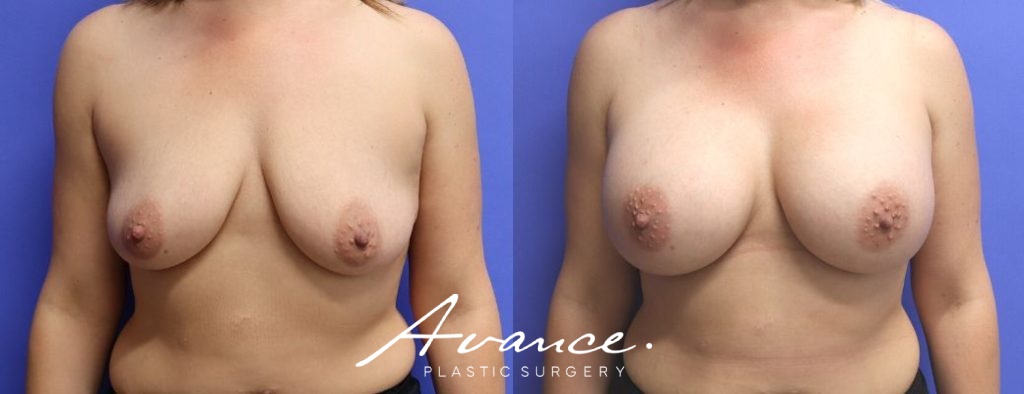 Before and After - Aumento de pecho
