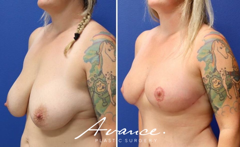 Before and After - Breast Lift