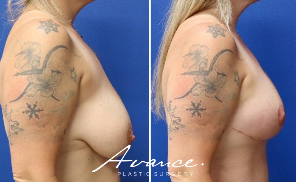 Before and After - Breast Lift