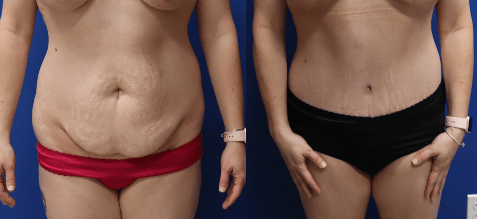 Before and After - Abdominoplastia