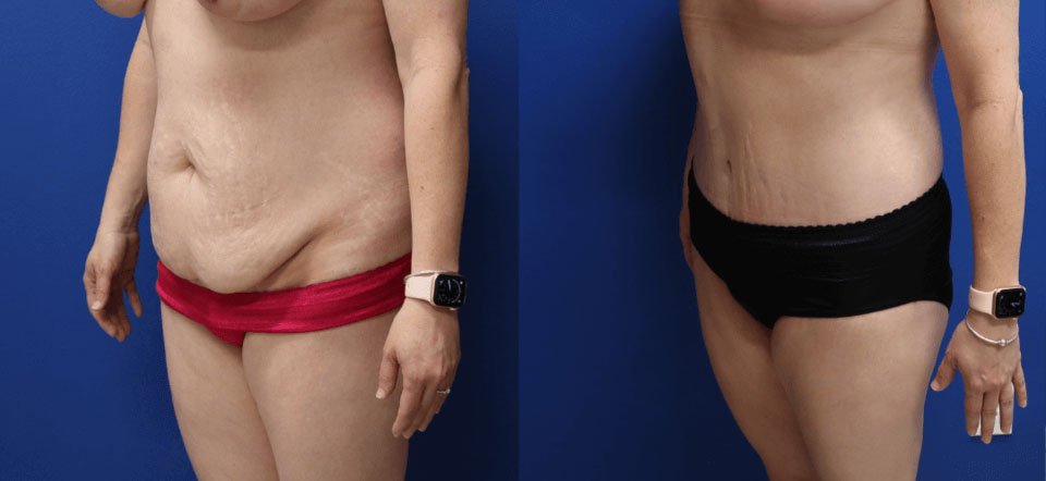 Before and After - Abdominoplastia