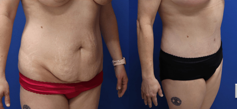 Before and After - Abdominoplastia