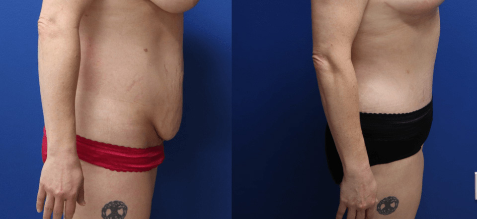 Before and After - Abdominoplastia