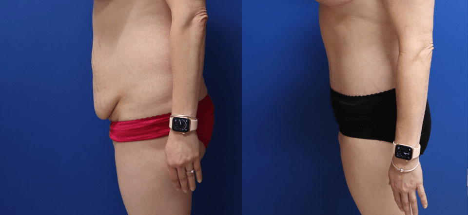 Before and After - Abdominoplastia