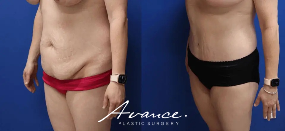 Before and After - Abdominoplasty