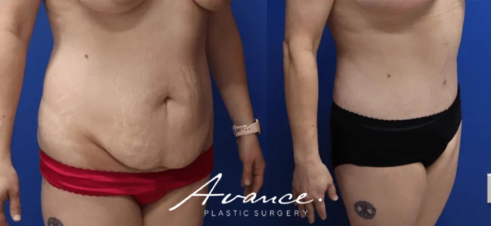 Before and After - Abdominoplasty