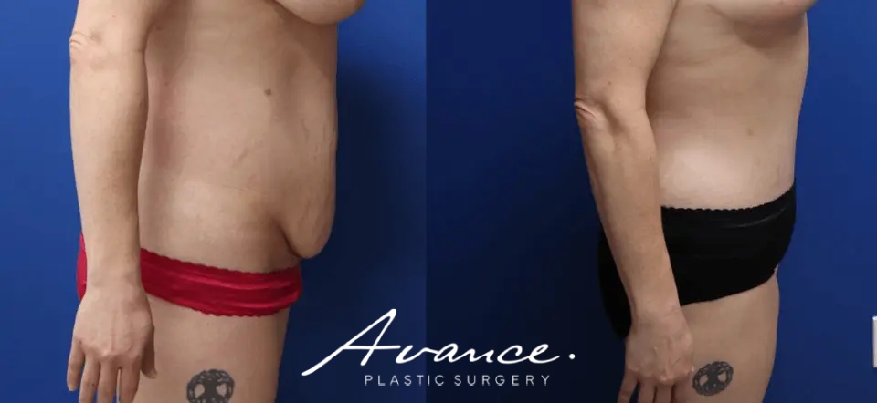 Before and After - Abdominoplasty