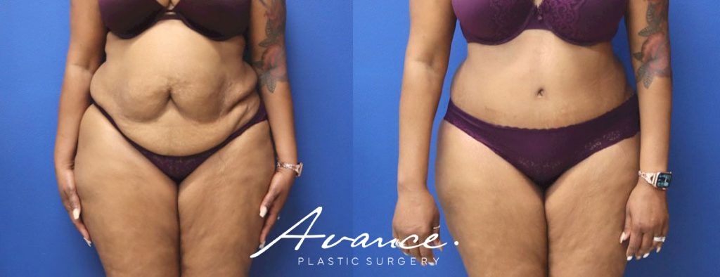 Before and After - Abdominoplasty