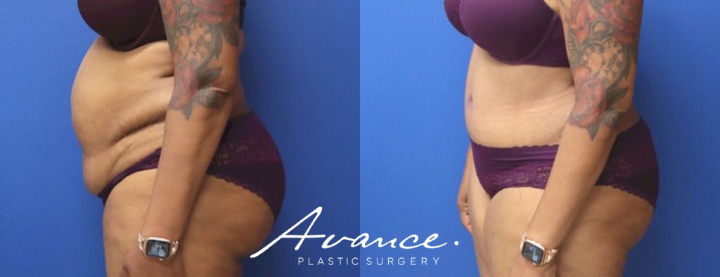 Before and After - Abdominoplasty