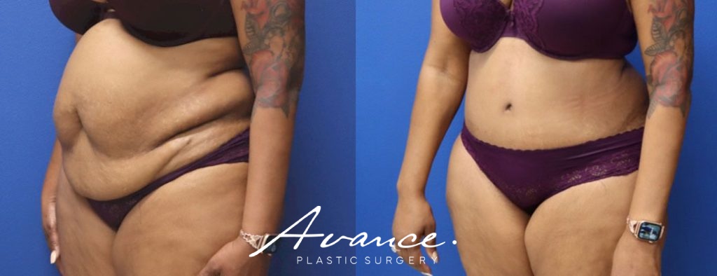 Before and After - Abdominoplasty