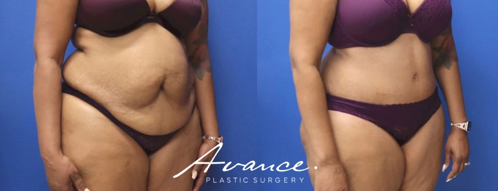 Before and After - Abdominoplasty