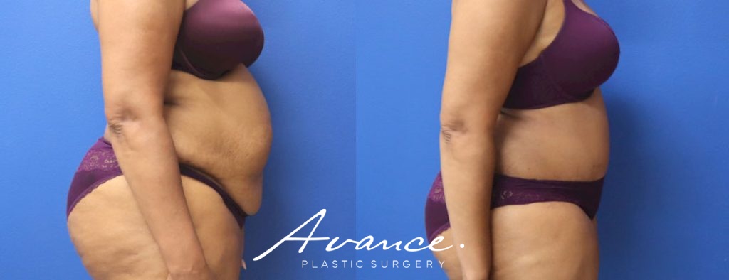 Before and After - Abdominoplasty