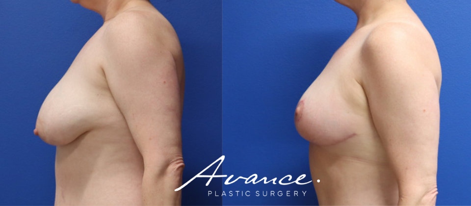 Before and After - Breast Lift