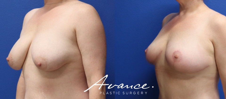Before and After - Breast Lift