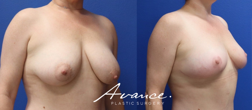 Before and After - Breast Lift