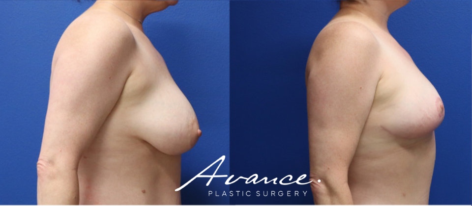 Before and After - Breast Lift