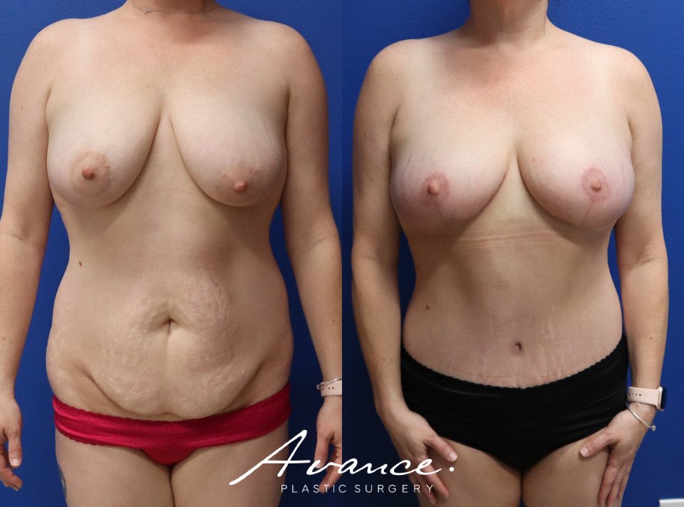 Before and After - Body