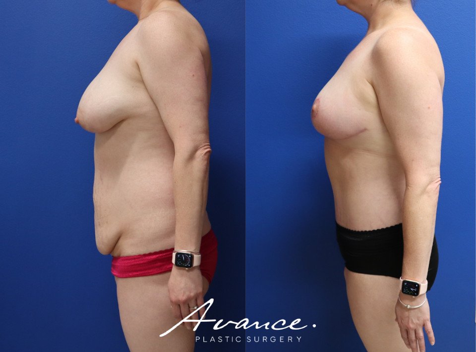 Before and After - Body