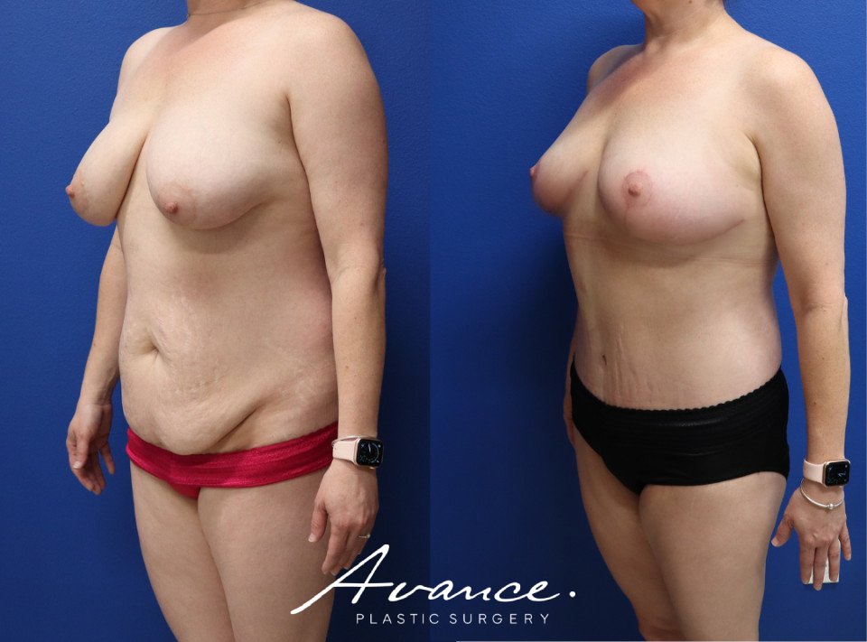 Before and After - Body